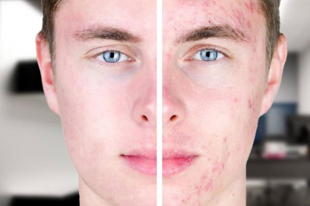 acne en hombres
