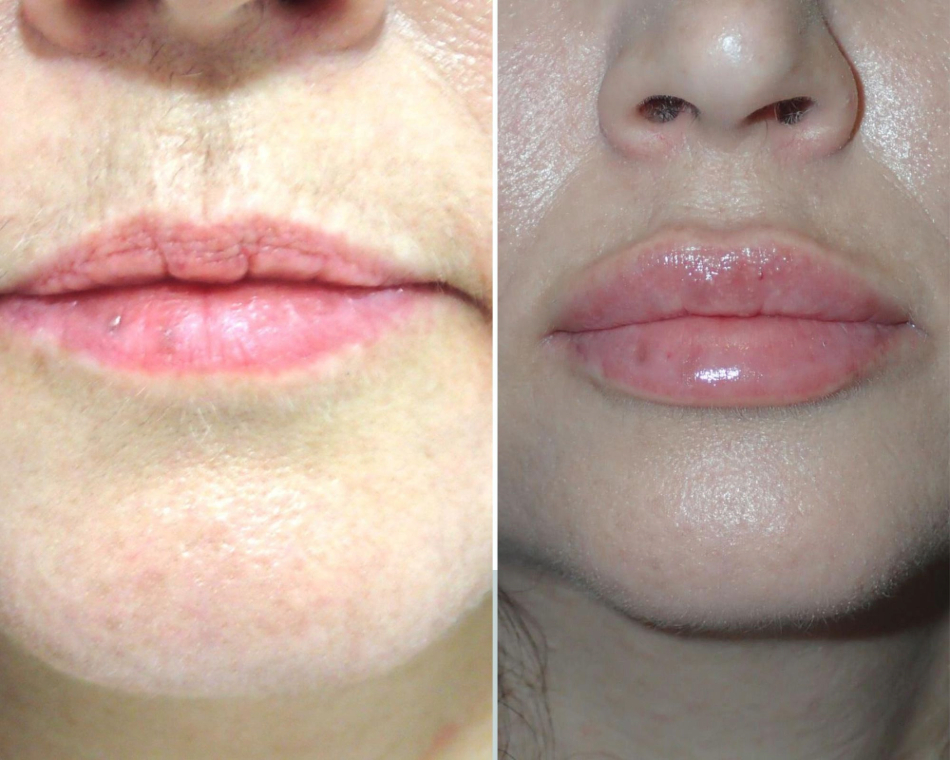 Aumento de labios Granada