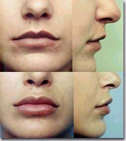 Aumento de labios Granada