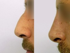 rinomodelacion nariz sin cirugia granada